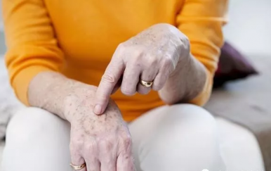 皮肤长老年斑怎么去掉，学会4招“吃”掉老年斑